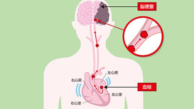 脳卒中を引き起こす脳への血栓の経路を示す図。心臓と脳のセクションがラベル付けされ、血管内の血栓が拡大表示されます。