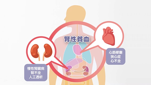 腎性貧血について